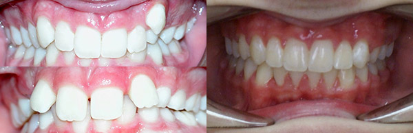 Orthodontic Case (Two Phase)