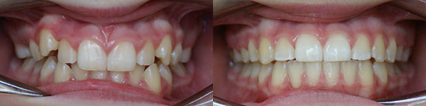 Orthodontic Case