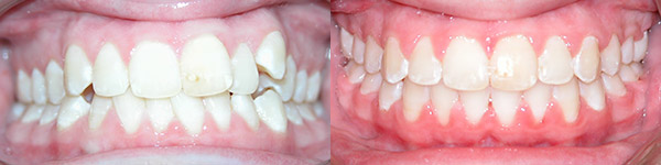 Orthodontic Case