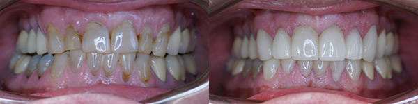 Crown and Veneer Case