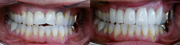 Crown and Veneer Case